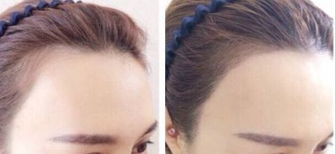 杭州疤痕整形哪家醫(yī)院好？選擇哪個醫(yī)院更靠譜？