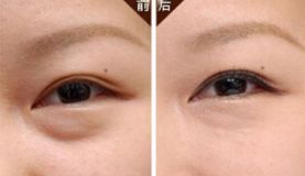沈陽哪家醫(yī)院做脂肪隆胸效果好且價格合理？