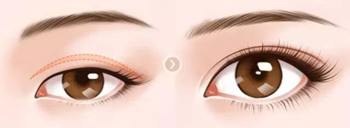 武漢美立方的胡江偉如何進(jìn)行雙眼皮手術(shù)？