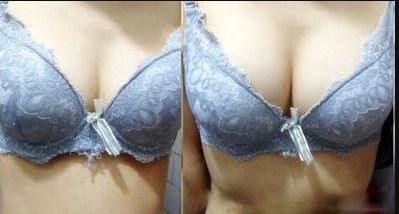 廣州哪家醫(yī)院的乳頭凹陷術(shù)效果好？