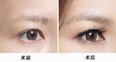 北京八大處醫(yī)院大牌醫(yī)生推薦！專治雙眼皮！