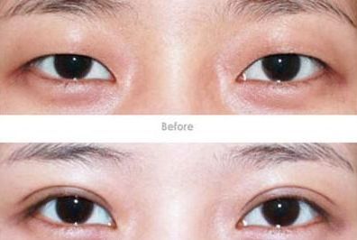 杭州開眼角醫(yī)生哪家好？專家推薦的杭州開眼角醫(yī)院排行榜