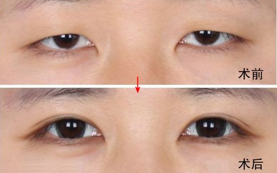 南京哪家醫(yī)院去眼袋好？眼袋手術(shù)選哪家醫(yī)院最好