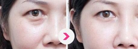 北京哪位醫(yī)生擅長巨乳縮小手術(shù)？5名實(shí)力醫(yī)生值得推薦