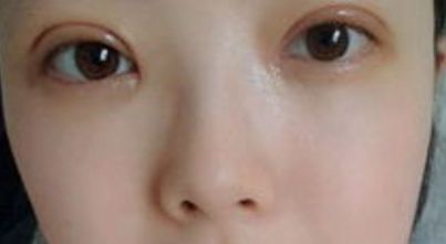 上海哪家醫(yī)院的雙眼皮手術效果最好？