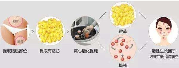 哈爾濱哪家醫(yī)院的去皺針效果好？