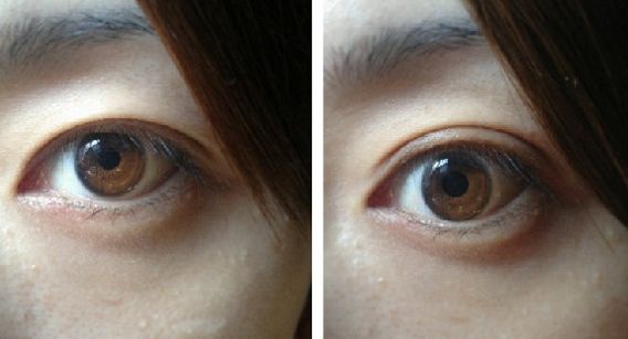 北京開(kāi)眼角好的醫(yī)院有哪些？