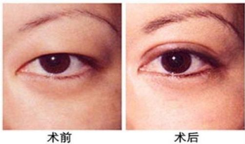 杭州做激光眼科手術哪家醫(yī)院好，專家推薦