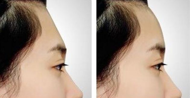 南京割雙眼皮哪家醫(yī)院效果好？