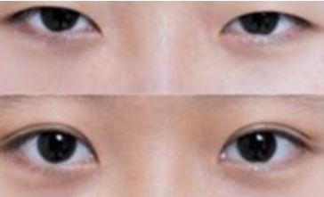 秦皇島雙眼皮哪家做的好？選擇前必看！