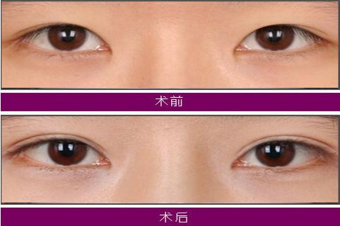 大連注射玻尿酸哪家醫(yī)院技術(shù)好，效果持久？