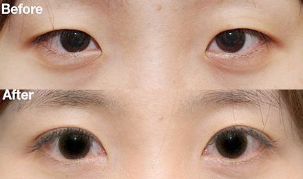 2023深圳黃金微針去除口周紋醫(yī)生綜合實(shí)力排行榜(鄭瑜璠、吳曉玲、劉彤大勢醫(yī)美重磅來襲)