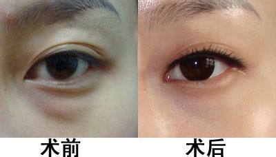 深圳雙眼皮修復(fù)，誰(shuí)是比較好的醫(yī)生？實(shí)力對(duì)比胡華新、李天石、白曉東等5位專家
