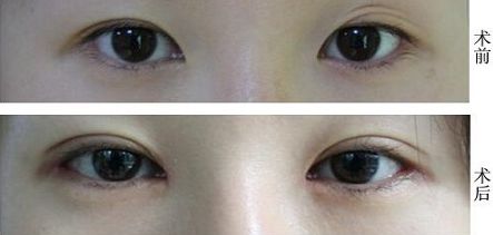 福州抽脂大腿哪家醫(yī)院好？挑選福州最靠譜的抽脂醫(yī)院有哪些？