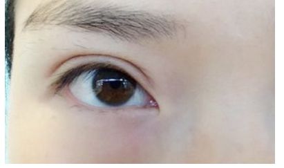 南昌祛痘哪家醫(yī)院口碑好，效果最佳？