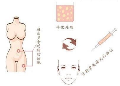廣州燒傷疤痕治療哪家醫(yī)院效果好，選擇哪家醫(yī)院最靠譜？