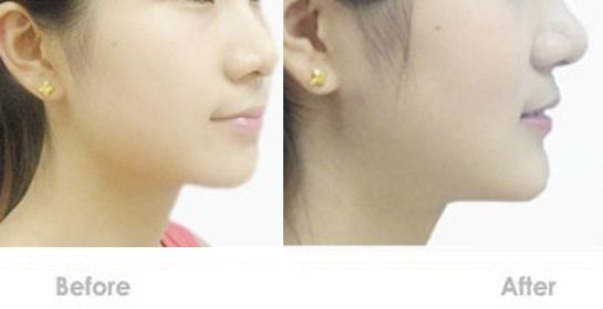 蘇州嘴唇改薄哪家醫(yī)院好？專業(yè)的整形醫(yī)院推薦