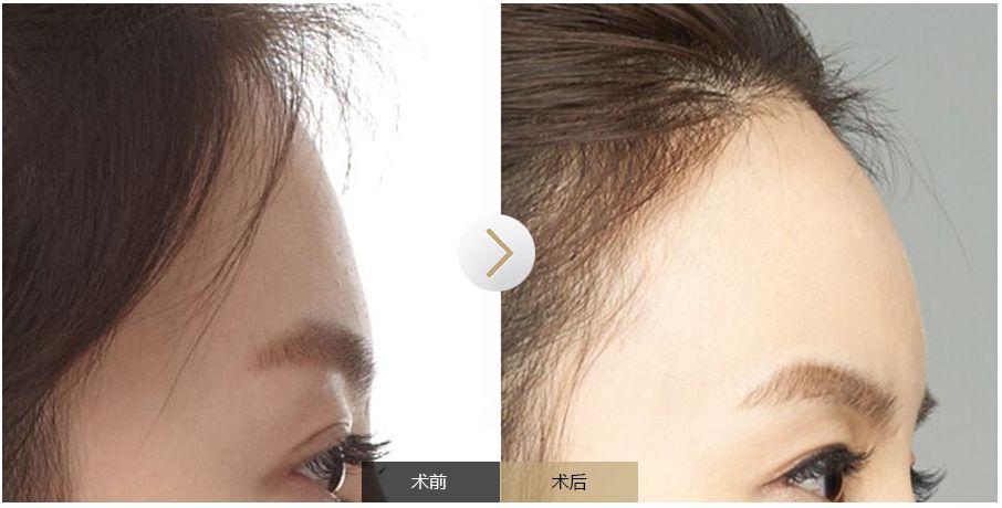 南寧點痣需求旺盛，哪家醫(yī)院是最受歡迎的？
