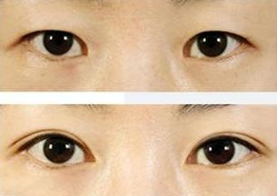 上海治療青春痘的專(zhuān)家推薦，哪家醫(yī)院效果最佳？