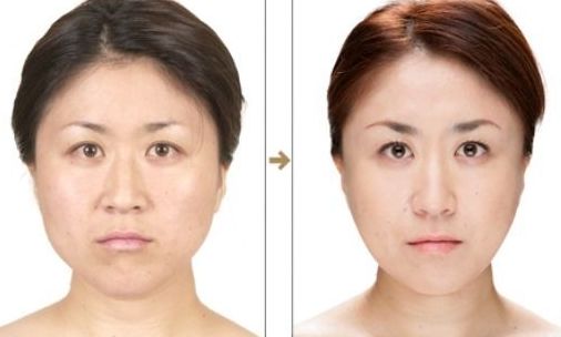 杭州整形醫(yī)院的抽脂效果如何？哪家醫(yī)院抽脂好？