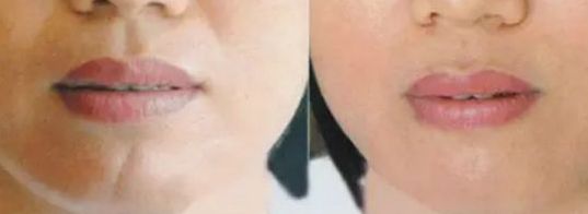 上海面部除疤效果最好的醫(yī)院有哪些？