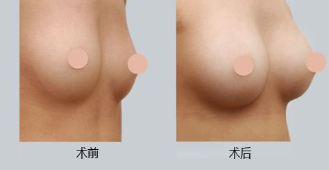 西安墊鼻梁技術(shù)好的醫(yī)院有哪些？