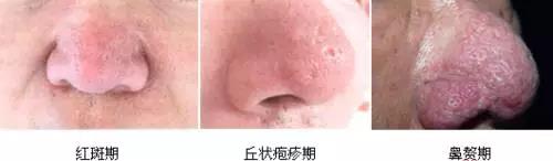 解密楊杰雙眼皮修復失敗案例圖，讓你心中的期望成為現(xiàn)實！