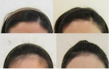 哈爾濱皮秒手術(shù)哪家醫(yī)院好？全面評測哈爾濱皮秒醫(yī)院排名