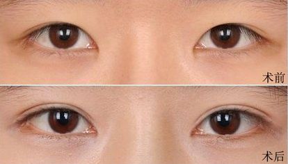 大連假體隆鼻哪家醫(yī)院好？打造完美鼻型，這家醫(yī)院是最佳選擇！