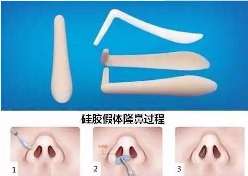北京哪家醫(yī)院祛除眼袋效果最好？