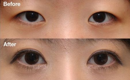 杭州雙眼皮醫(yī)院排名Top1，哪家醫(yī)院做雙眼皮效果好？