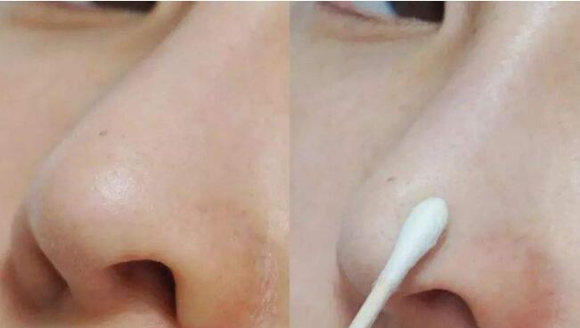重慶華美整形美容醫(yī)院韋志遠(yuǎn)疤痕修復(fù)效果體驗分享