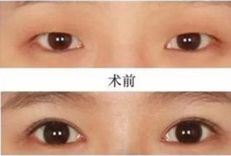 昆明哪家醫(yī)院做熱瑪吉好？挑選昆明熱瑪吉治療專(zhuān)業(yè)的醫(yī)院指南