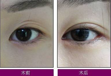 煙臺整疤痕哪家醫(yī)院好？了解煙臺整疤痕醫(yī)院的綜合評價和治療效果
