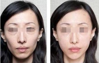 深圳蛋白線提升面部醫(yī)院排名及費(fèi)用對(duì)比-找到最適合你的提升方案