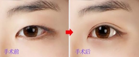 上海玻尿酸豐唇哪家醫(yī)院好？挑選上?？诒玫牟Ｄ蛩嶝S唇醫(yī)院