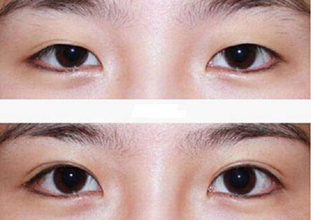 【2023年蘭州歪脖子手術(shù)哪家好？專家推薦+真實案例分析】