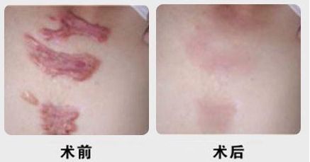 昆明有沒(méi)有哪家專(zhuān)業(yè)祛痘醫(yī)院值得推薦？