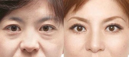 成都做乳暈漂紅哪家好？乳暈漂紅的價格、效果、方法哪種最合適？