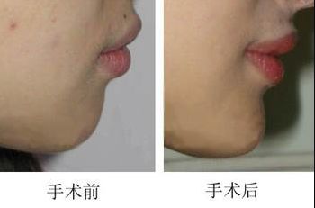 昆明哪家醫(yī)院做上臉下垂手術(shù)好，醫(yī)生技術(shù)靠譜？