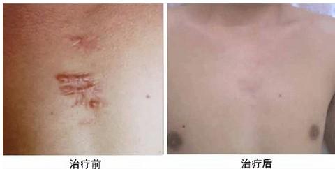 2023南寧做玻尿酸隆胸推薦前10位專家(麥慧、李冰、胡凱技術(shù)屬實，價格讓你參考)
