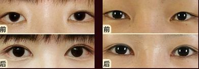 嘟嘟唇無(wú)錫哪家醫(yī)院好？專家推薦無(wú)錫哪家醫(yī)院治療嘟嘟唇好