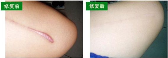 上海微創(chuàng)除皺哪家醫(yī)院好？了解上海微創(chuàng)除皺治療的專業(yè)醫(yī)院推薦