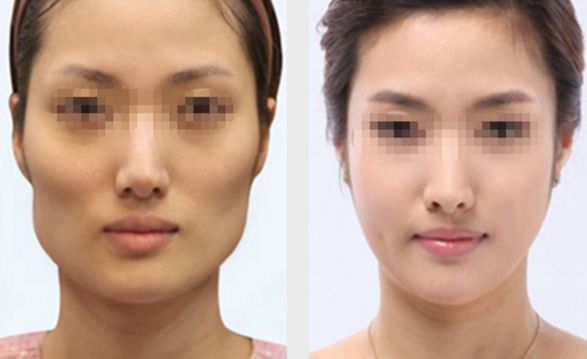 長春雙眼皮修復(fù)好的醫(yī)院有哪些？