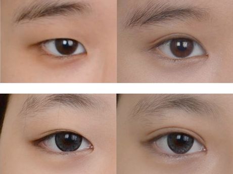 修復過寬雙眼皮手術(shù)，寬度調(diào)整方案推薦
