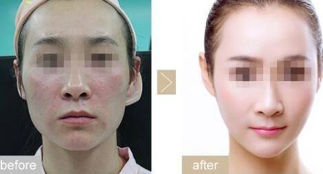 眼瞼內翻手術的優(yōu)勢與效果