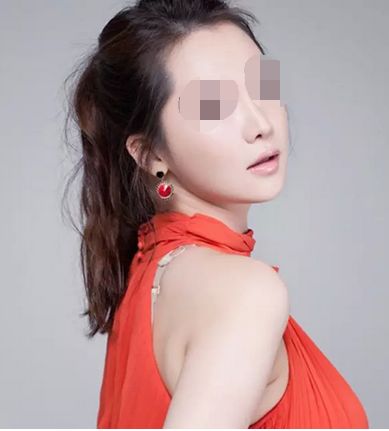 雙眼皮整形術(shù)術(shù)后需要注意些什么？