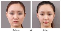 矯正牙齒需預(yù)估費(fèi)用？費(fèi)用注意事項(xiàng)解析！