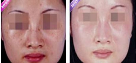 激光縮陰是否會導(dǎo)致副作用？找到安全有效的解決方法