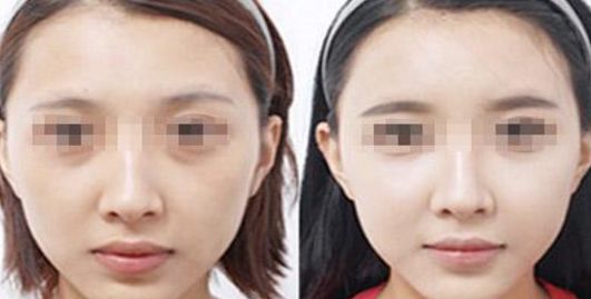 容城洗牙價格一覽，潔牙需花多少錢？